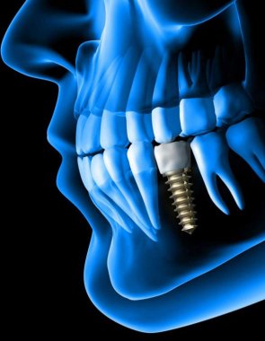 Dental Implants