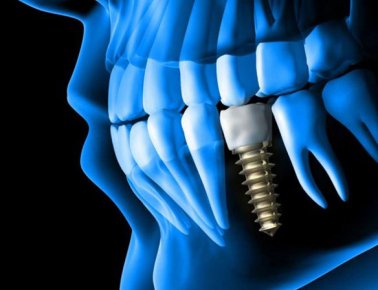 Dental Implants