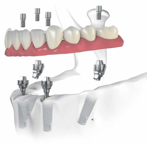 All on Four Implant Treatment