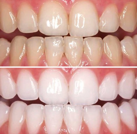 Teeth Whitening (Bleaching)