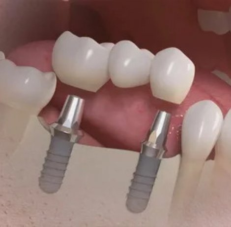 Regional Teeth Deficiency