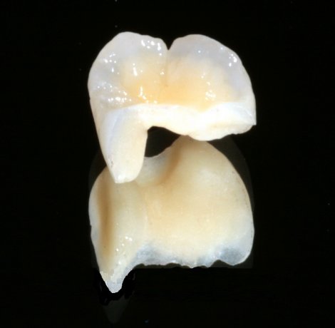 Porcelain Fillings (Inlay/Onlay)