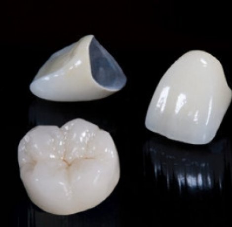 Porcelain Crowns